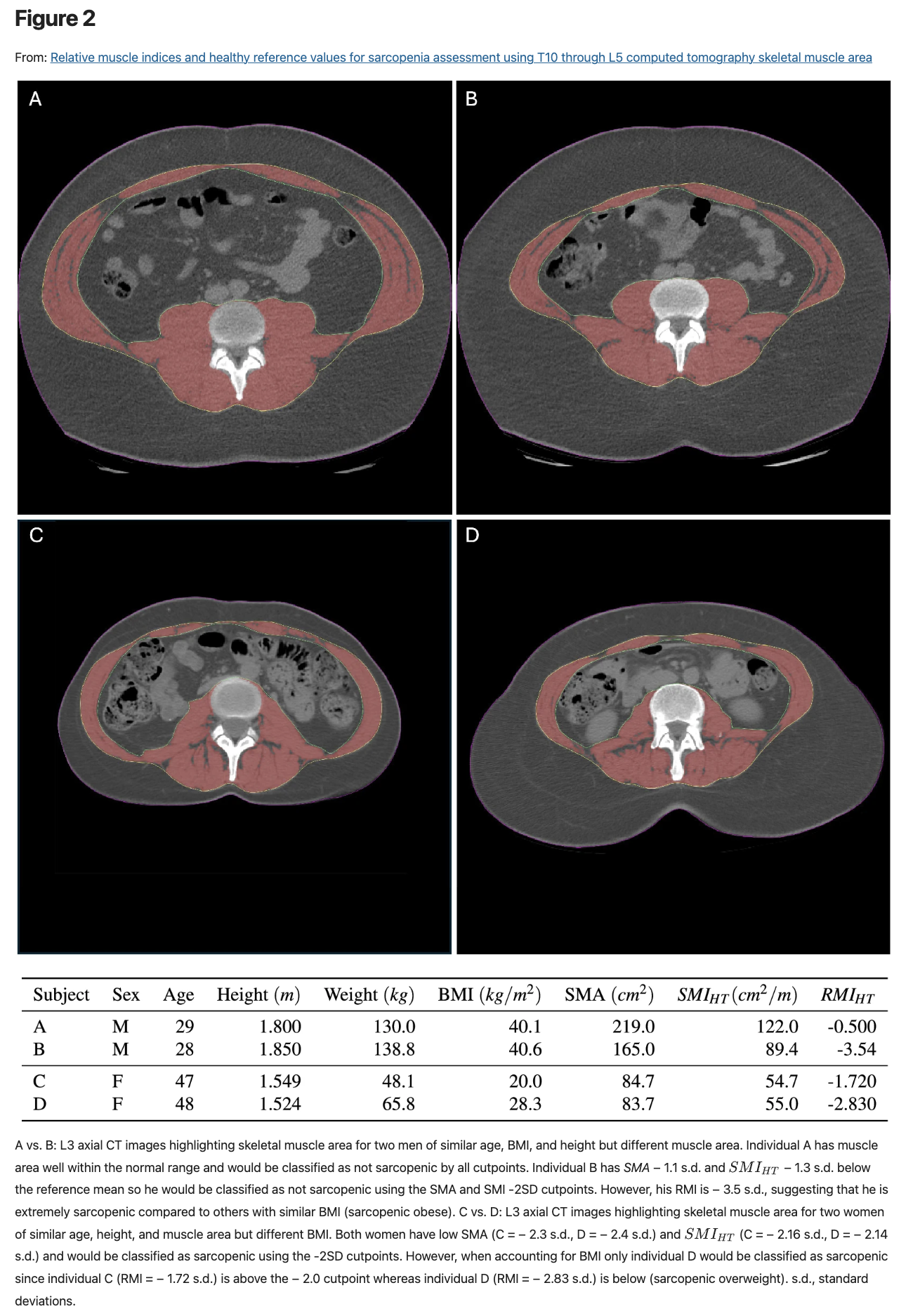 Figure from one of Brian Derstine's articles showing CT images of four human torsos. 