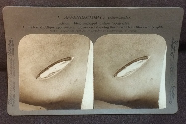 One of 35 stereoscopic cards from  Frank Hartley & Alfred Swaine Taylor. Operative Surgery through the Stereoscope. Appendectomy (New York & London: Underwood & Underwood, ca. 1908)